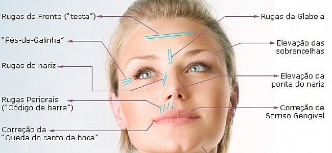 Botox: tratamento de rugas e marcas de expressão 8 BOTOX