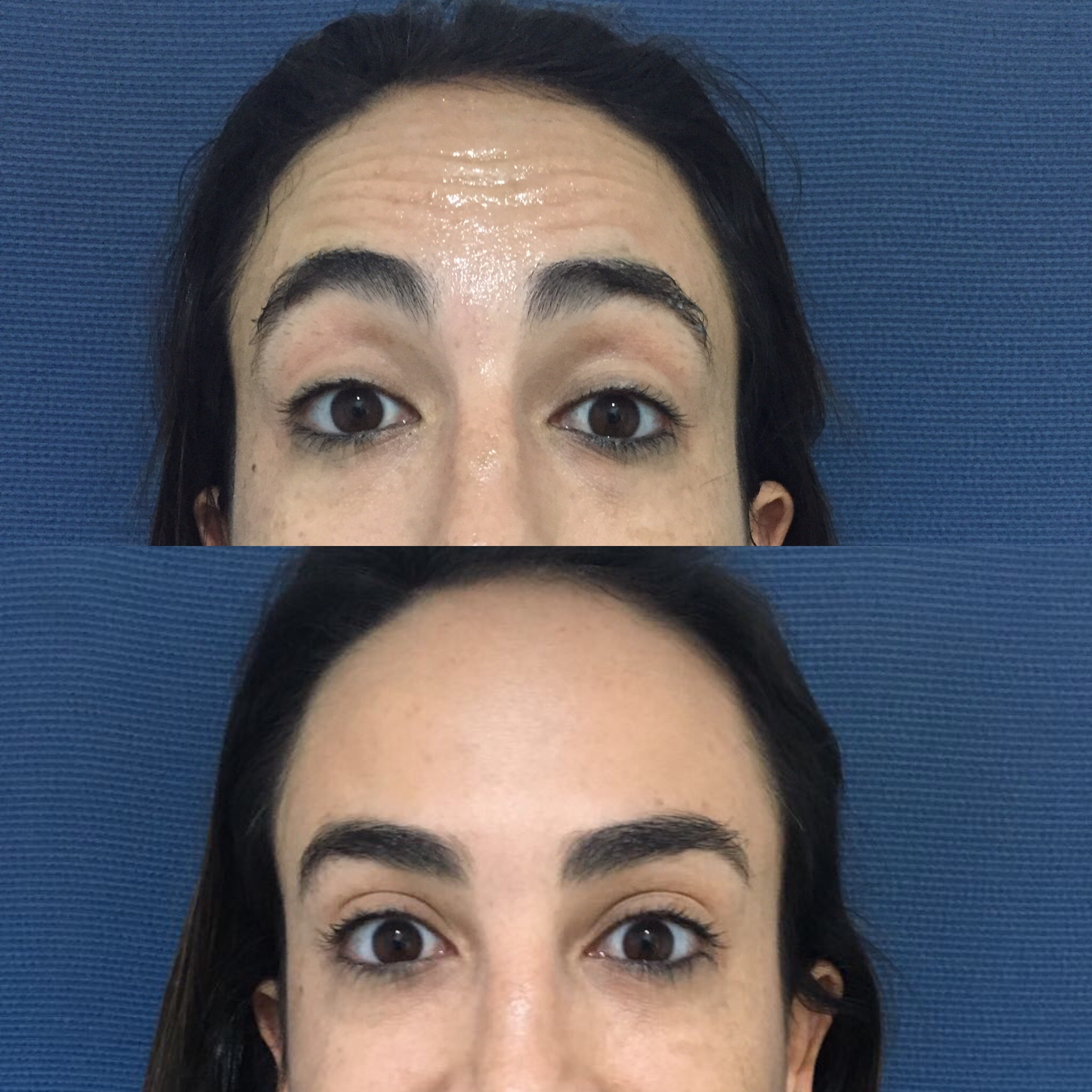 Botox: tratamento de rugas e marcas de expressão 12 IMG_0288