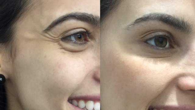 Botox: tratamento de rugas e marcas de expressão 10 IMG_4230