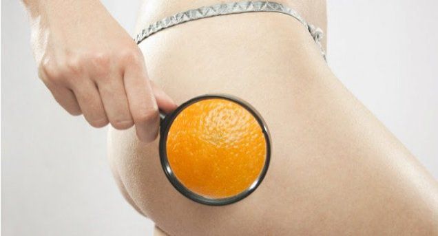 Vamos falar sobre Celulite? Causas e tratamentos 5 Celulite