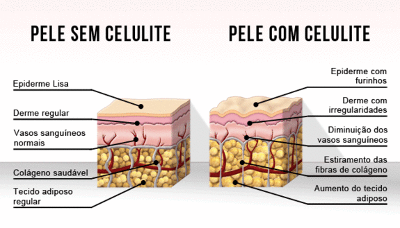 Vamos falar sobre Celulite? Causas e tratamentos 6 celulite