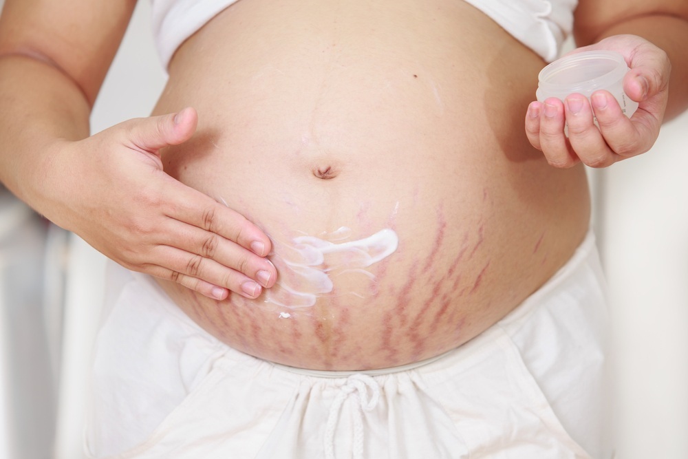 mulher gravida passando creme sobre a pele com estrias foto baipoohshutterstockcom 0000000000015D651
