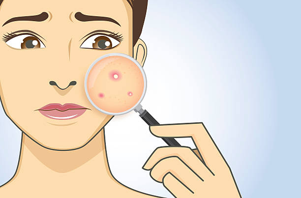 Acne: Por quê eu tenho? 1 acne