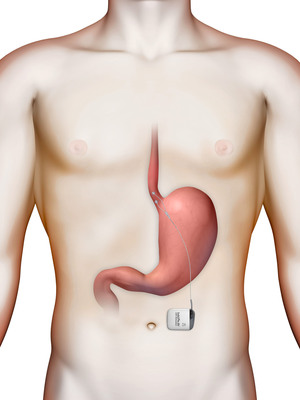 Tratamento endoscópico e reversível da obesidade 6 14