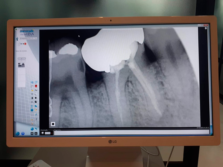 jf implantes 12
