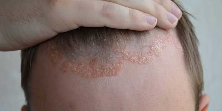 maneiras naturais para aliviar a psoríase
