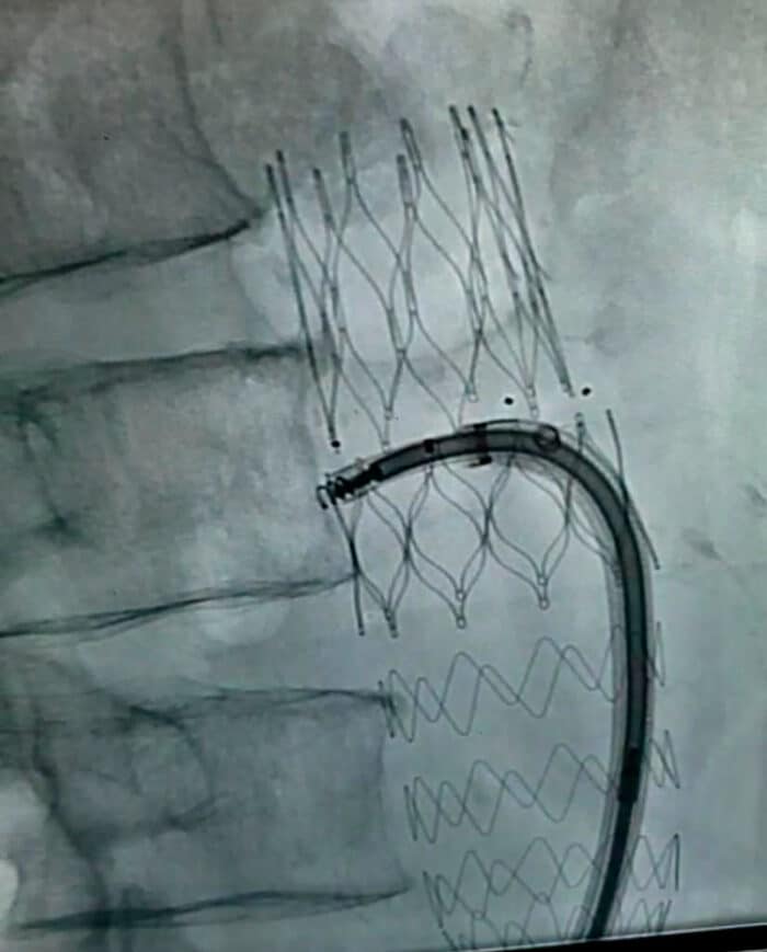 Santa Casa JF: técnicas inéditas para pacientes cardíacos 3 valve in valve1