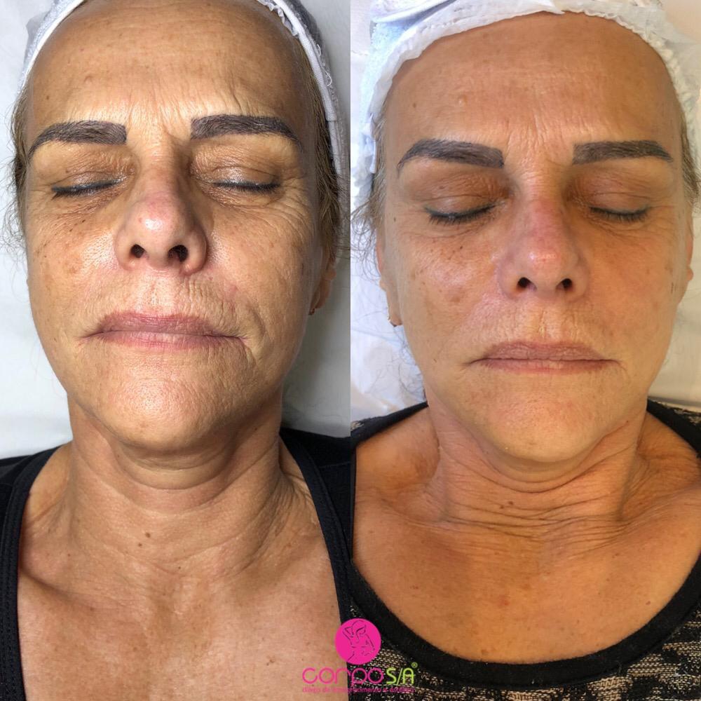 Rejuvenescimento facial: aproveite o inverno 1 https://corposaestetica.com.br/