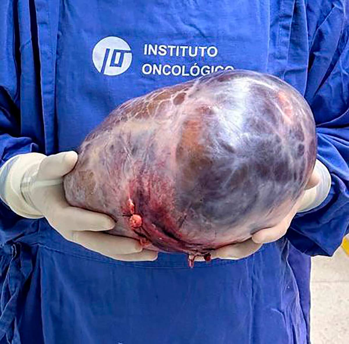 Tumor de quase 5kg é retirado de mulher em Juiz de Fora 1 tumor 5kg foto arquivo pessoal 2