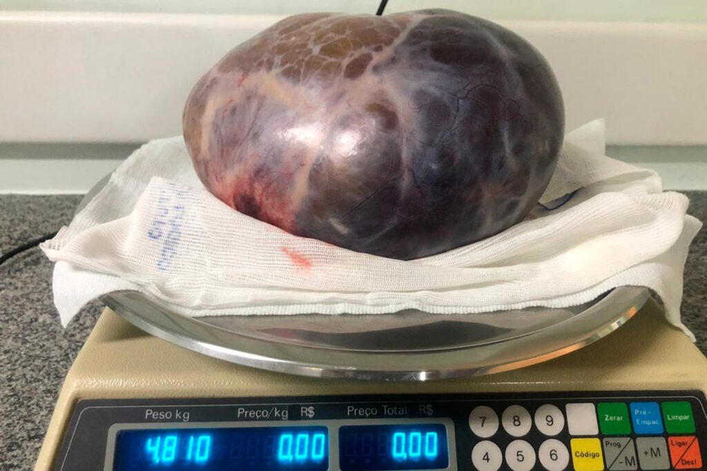 Tumor de quase 5kg é retirado de mulher em Juiz de Fora 3 tumor 5kg foto arquivo pessoal site dest