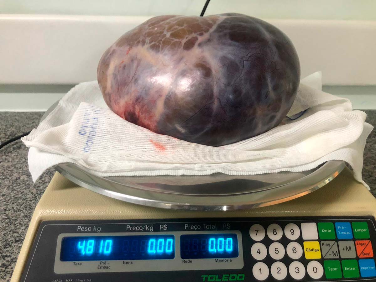 Tumor de quase 5kg é retirado de mulher em Juiz de Fora 2 tumor 5kg foto arquivo pessoal