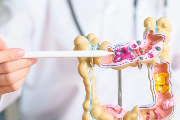 Mortalidade por câncer colorretal cresce 20% na América Latina 1 cancer colorretal foto agencia einstein