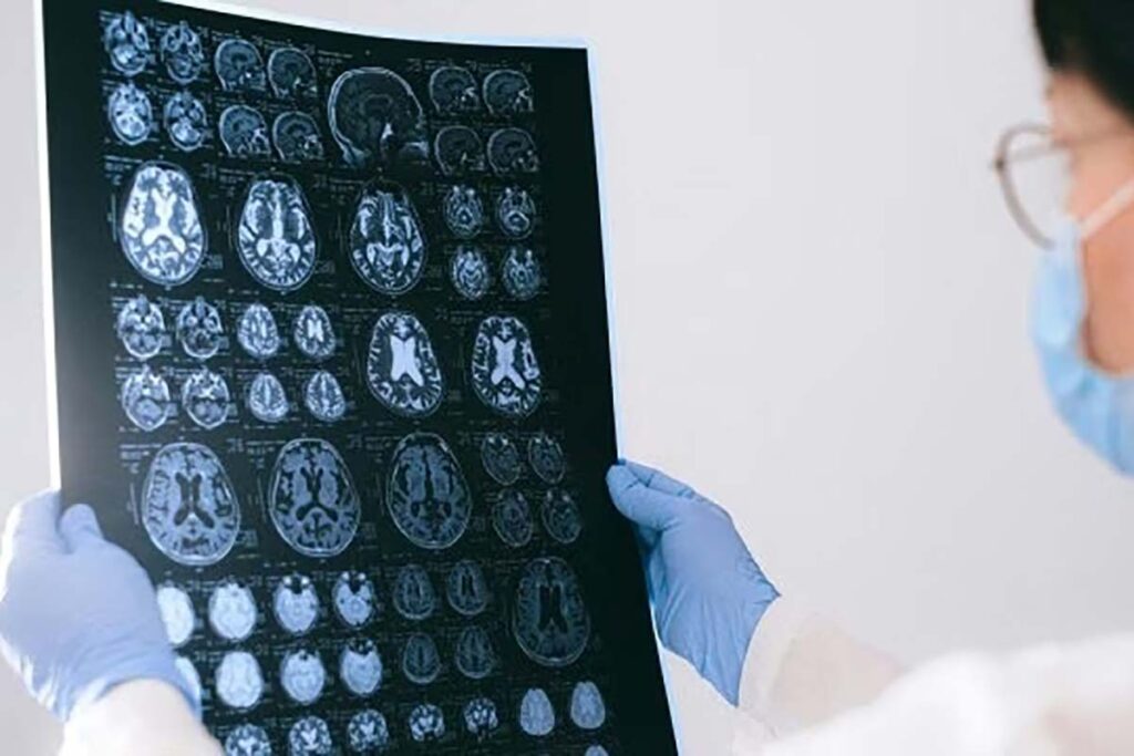 EUA reconhece eficácia de droga no tratamento para Alzheimer 2 transamérica