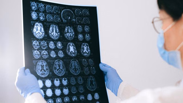 Alzheimer