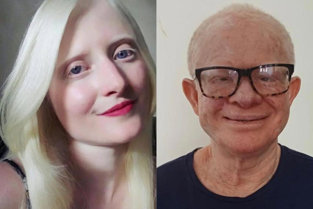 Movimentos buscam garantir direitos a pessoas com albinismo 3 elizabet e joselito albinismo montagem com fotos de arquivo pessoal