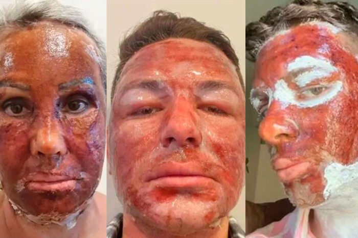 Peeling de fenol: entenda o procedimento ligado à morte de jovem 2 peeling de fenol