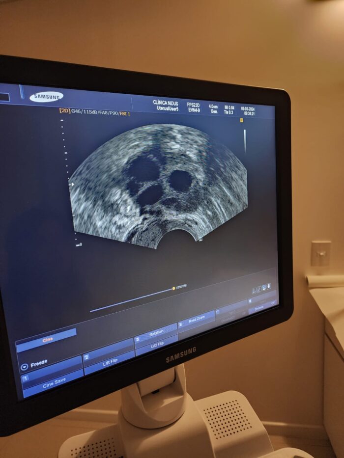 Fertilização in vitro pelo SUS ainda é desafio para pessoas que sonham com filhos 2 WhatsApp Image 2024 07 09 at 20.52.56 1