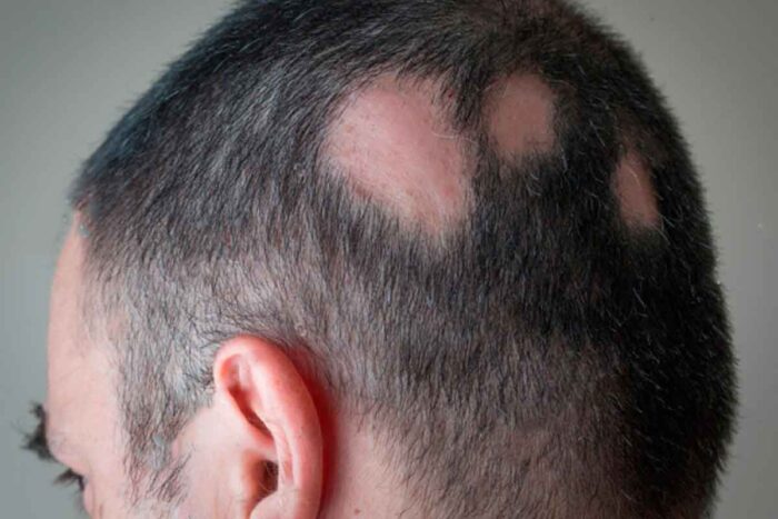 Alopecia: novo estudo destaca aspecto emocional da doença que causa perda súbita de cabelo 1 alopecia estudo pfizer