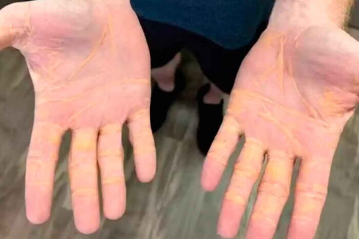 Dieta carnívora realmente faz bem para a saúde? Entenda os riscos 1 colesterol dieta carnivora reproducao redes sociais