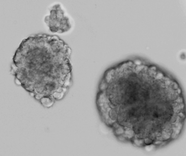 Estudo revela proteína-chave para a progressão de tipo de tumor cerebral 2 Estudo revela proteína-chave para a progressão de tipo de tumor cerebral