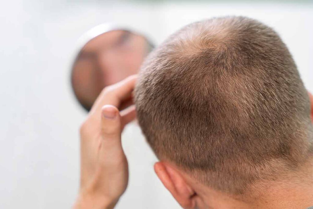 Ozempic pode causar queda de cabelo e queimação na pele, alertam dermatologistas