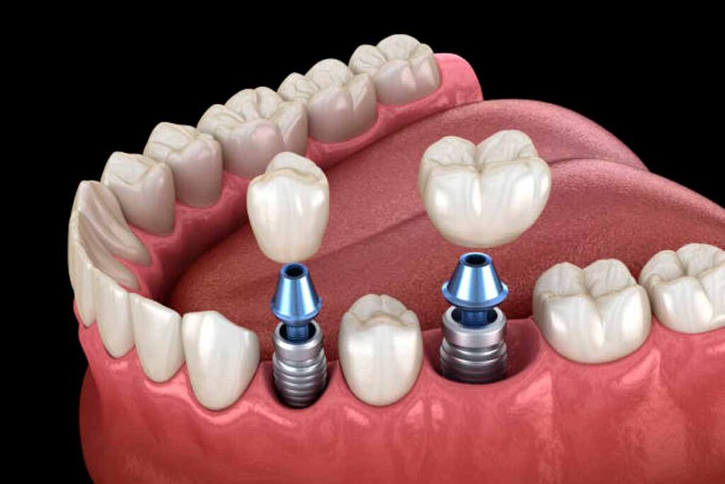 AO VIVO: notícias, doença inflamatória intestinal, implantes dentários e mães empreendedoras: acompanhe a Tribuna Transamérica 1 implante dentario foto iStock