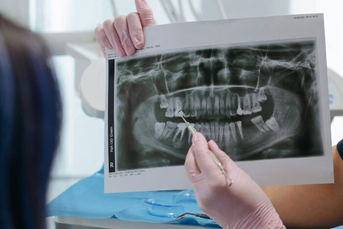 Paciente que teve dente extraído por engano tem indenização negada pela Justiça em Minas 1 indenização foi negada pela Justiça