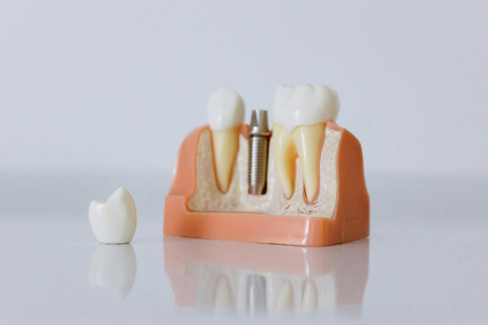 Clínica odontológica é condenada a pagar R$ 38 mil após falhas em implantes dentários 1 implante dentário