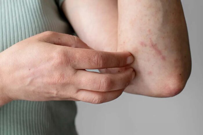 Estudo descobre por que algumas pessoas reagem a aspirina e ibuprofeno 1 Relação entre alergia aos ácaros e reações aos anti-inflamatórios é explicada por pesquisadores