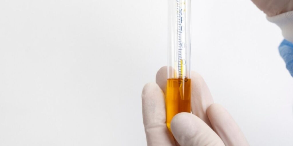Sangue na urina uma única vez e sem qualquer dor pode revelar doença desconhecida por 81% dos idosos
