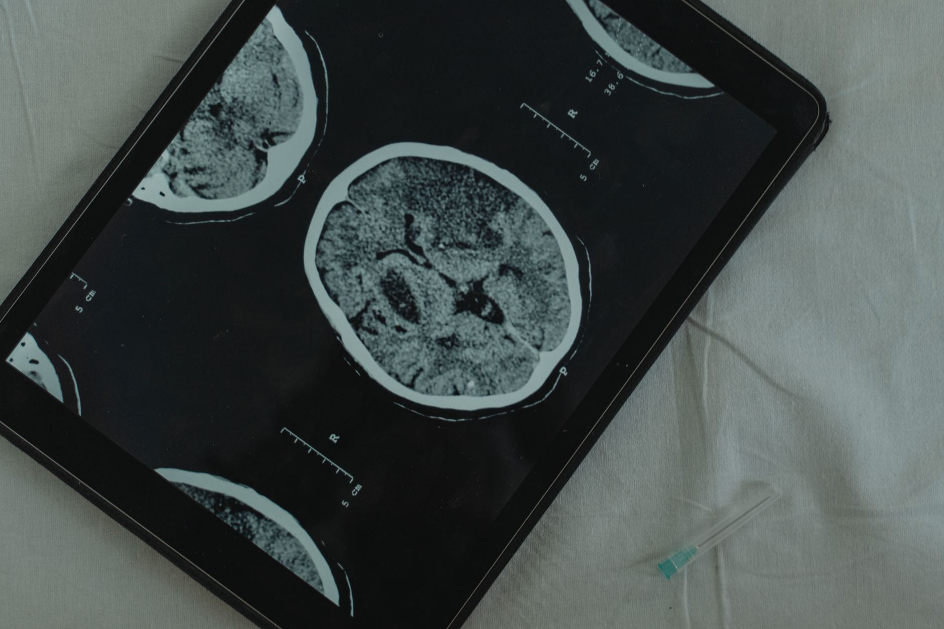 Vista em close de uma tomografia computadorizada do cérebro exibida em um tablet digital com uma agulha médica ao lado.