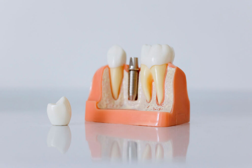 Clínica terá que pagar mais de R$ 43 mil a idosa por falhas em implantes dentários em MG 1 implante dentario foto pexels