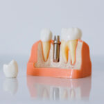 implante dentario foto pexels
