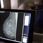 Planos de saúde terão que cobrir mamografia digital sem restrição de idade 17 Planos de saúde terão que cobrir mamografia digital sem restrição de idade