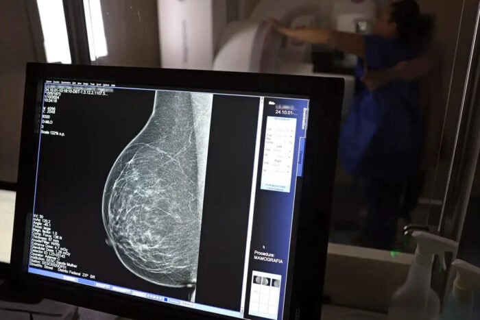 Planos de saúde terão que cobrir mamografia digital sem restrição de idade