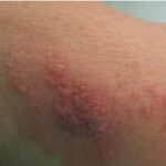 O avanço da Herpes 15 zoster