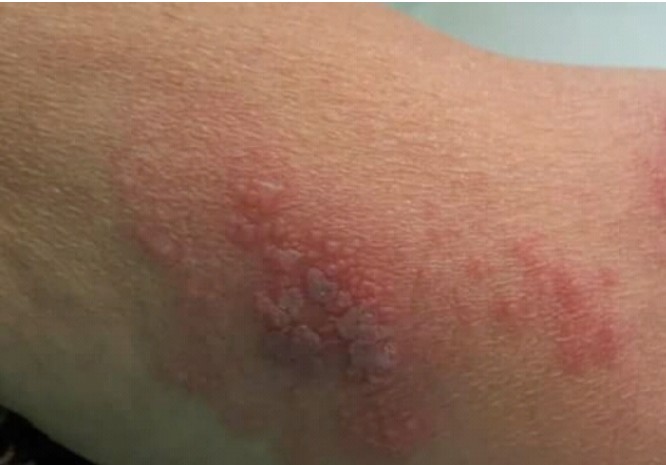O avanço da Herpes